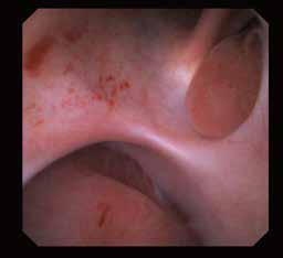Ureteroscopio flexible Scivita - Viztrol