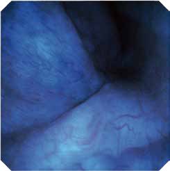 Ureteroscopio flexible Scivita - Viztrol